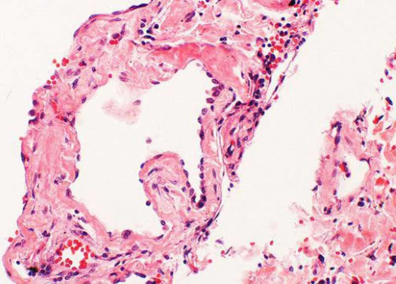 Amiloidosi