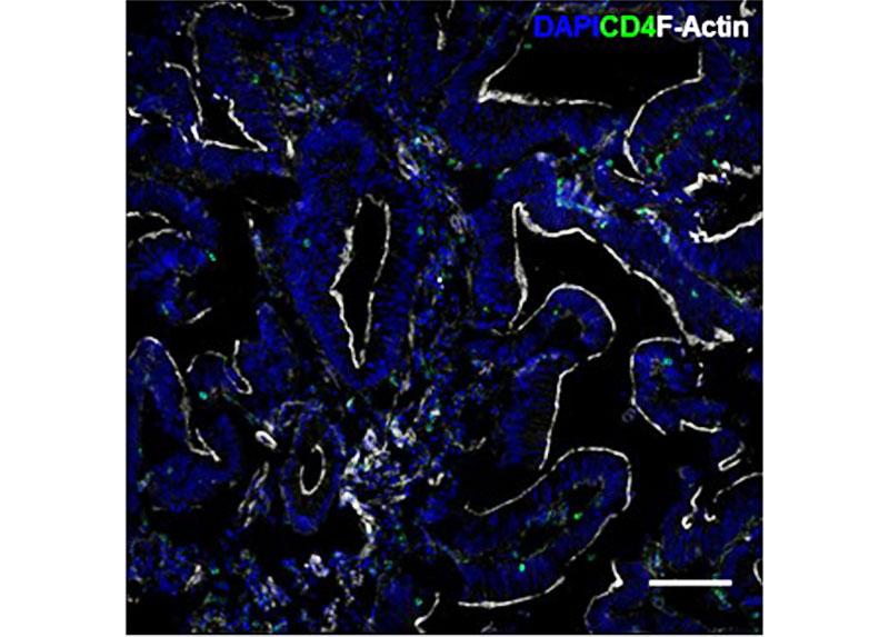 Human colorectal cancer tissue and relative infiltrating CDA+ Treg