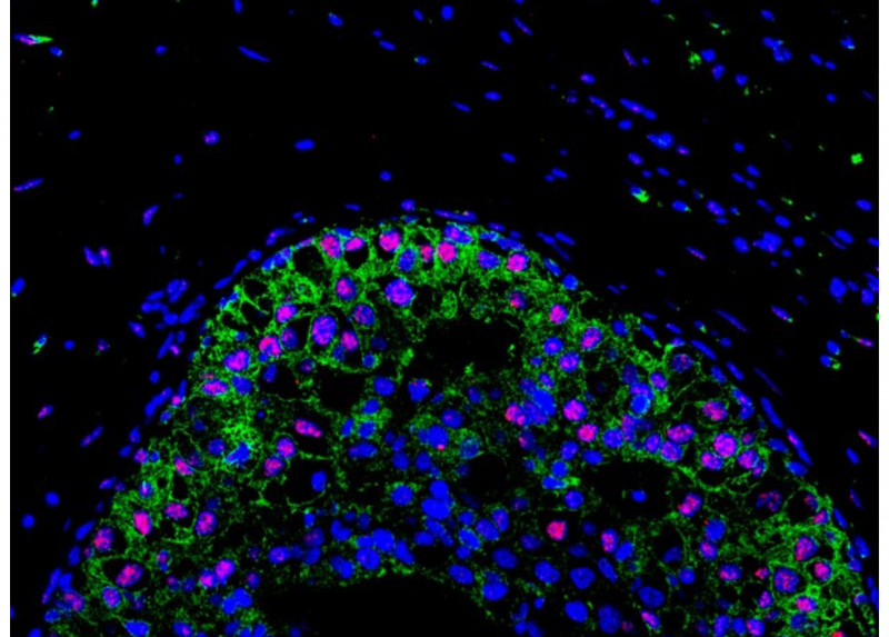 Immagini ottenute da analisi al microscopio confocale di fronti invasivi di carcinoma mammario derivati da campioni di pazienti. Lungo il fronte si può osservare l’aumento di espressione di RAB5A (verde) e l’accumulo di segnale di un marker di danno al DNA nucleare: γH2AX (in rosso). In blu il segnale corrispondente ai nuclei
