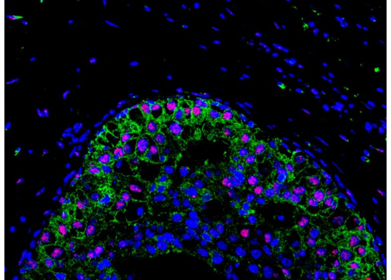 Immagini ottenute da analisi al microscopio confocale di fronti invasivi di carcinoma mammario derivati da campioni  di pazienti. Lungo il fronte si può osservare l’aumento di espressione di RAB5A (verde) e l’accumulo di segnale di un marker di danno al DNA nucleare: γH2AX (in rosso). In blu il segnale corrispondente ai nuclei