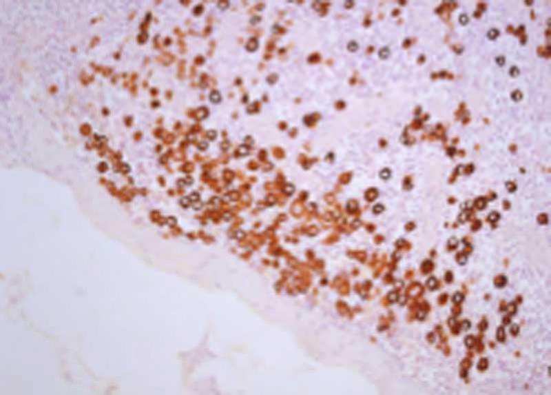 Micro-metastatsi linfonodali di tumore mammario