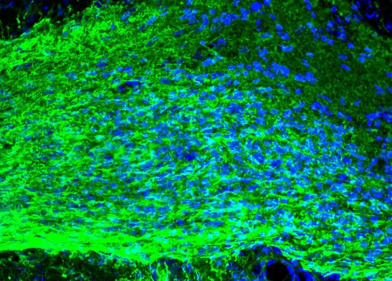 Sclerosi multipla - vescicole extracellulari