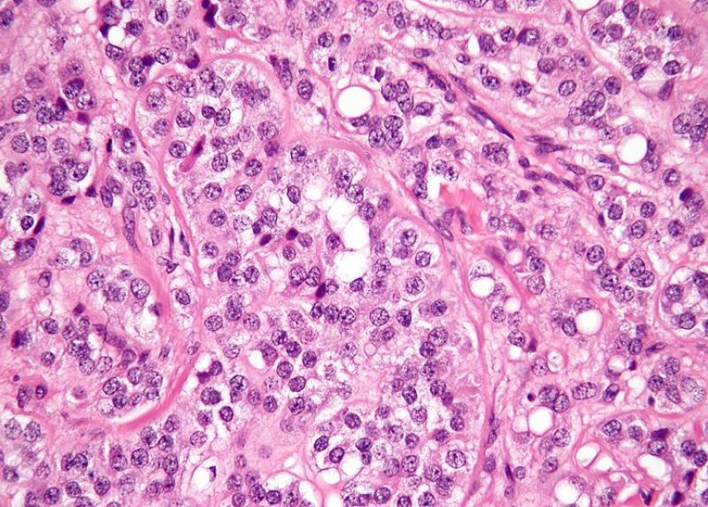 Cellule tumorali al microscopio