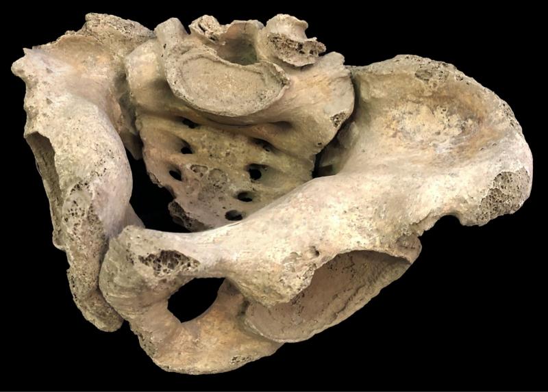 La gravidanza e l’osteomalacia nell'Alto Medioevo: analisi bioarcheologica rivela carenza di vitamina D da probabile celiachia.